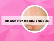 银屑病基因遗传图 银屑病是不是基因有缺陷