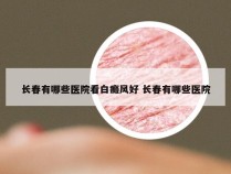 长春有哪些医院看白癜风好 长春有哪些医院