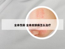 全身性藓 全身皮肤癣怎么治疗