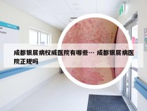 成都银屑病权威医院有哪些… 成都银屑病医院正规吗