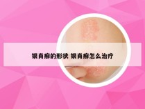 银肖癣的形状 银肖癣怎么治疗