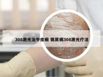 308激光治牛皮癣 银屑病308激光疗法