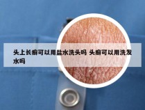 头上长癣可以用盐水洗头吗 头癣可以用洗发水吗