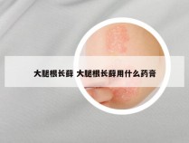 大腿根长藓 大腿根长藓用什么药膏