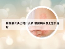 银屑病长头上吃什么药 银屑病头发上怎么治疗