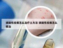 顽固性皮癣怎么治疗土方法 顽固性皮癣怎么根治