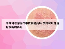 孕期可以涂治疗牛皮癣的药吗 孕妇可以抹治疗皮癣的药吗