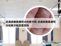 点滴状银屑病可以吃桃子吗 点滴状银屑病可以吃桃子吗百度百科