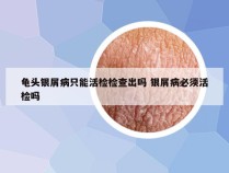 龟头银屑病只能活检检查出吗 银屑病必须活检吗