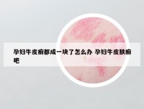 孕妇牛皮癣都成一块了怎么办 孕妇牛皮肤癣吧