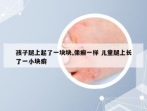 孩子腿上起了一块块,像癣一样 儿童腿上长了一小块癣