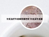 针炙治疗午皮癣效果咋样 针灸治牛皮廨