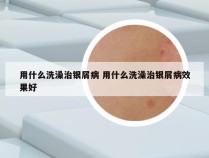 用什么洗澡治银屑病 用什么洗澡治银屑病效果好