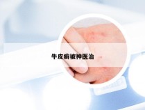 牛皮癣被神医治