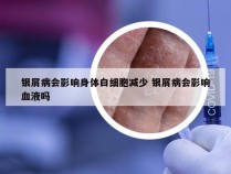 银屑病会影响身体白细胞减少 银屑病会影响血液吗