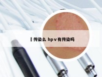 廯传染么 hpⅴ有传染吗