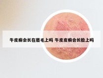 牛皮癣会长在眉毛上吗 牛皮皮癣会长脸上吗