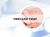 干癣用什么药膏 干癣治疗