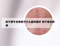 南宁看牛皮癣南宁什么医院最好 南宁看皮肤病