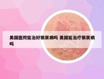 美国医院能治好银屑病吗 美国能治疗银屑病吗