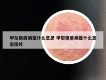 甲型银屑病是什么意思 甲型银屑病是什么意思图片