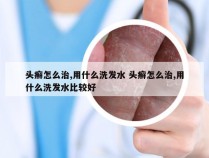 头癣怎么治,用什么洗发水 头癣怎么治,用什么洗发水比较好