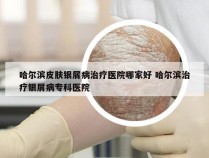 哈尔滨皮肤银屑病治疗医院哪家好 哈尔滨治疗银屑病专科医院