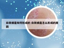 白斑病是如何形成的 白斑病是怎么形成的原因