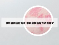 甲银屑病治疗方法 甲银屑病治疗方法有哪些