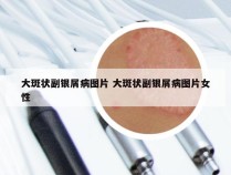 大斑状副银屑病图片 大斑状副银屑病图片女性