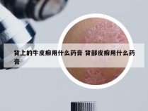 背上的牛皮癣用什么药膏 背部皮癣用什么药膏