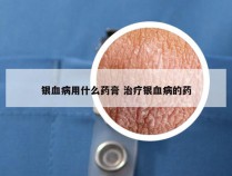 银血病用什么药膏 治疗银血病的药