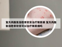 复方丙酸氯倍他索软膏治疗银屑病 复方丙酸氯倍他索软膏可以治疗银屑病吗