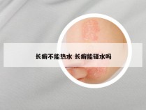 长癣不能热水 长癣能碰水吗