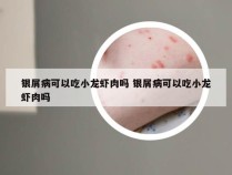 银屑病可以吃小龙虾肉吗 银屑病可以吃小龙虾肉吗