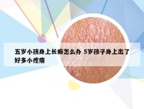 五岁小孩身上长癣怎么办 5岁孩子身上出了好多小疙瘩