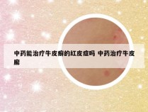 中药能治疗牛皮癣的红皮症吗 中药治疗牛皮廨