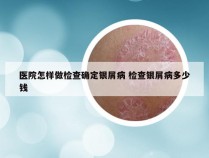 医院怎样做检查确定银屑病 检查银屑病多少钱