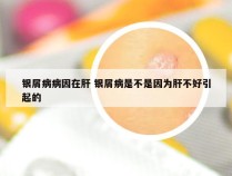 银屑病病因在肝 银屑病是不是因为肝不好引起的