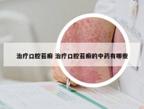 治疗口腔苔癣 治疗口腔苔癣的中药有哪些