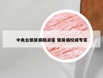 中央台银屑病杨淑莲 银屑病权威专家