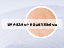 银屑病爆发期治疗 银屑病爆发期治疗方法