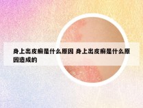 身上出皮癣是什么原因 身上出皮癣是什么原因造成的