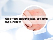 成都治疗银屑病哪家医院比较好 成都治疗银屑病最好的医院