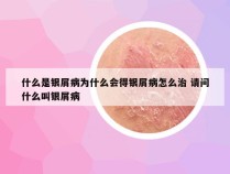 什么是银屑病为什么会得银屑病怎么治 请问什么叫银屑病