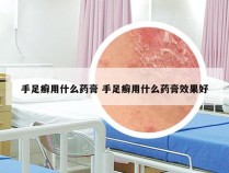 手足癣用什么药膏 手足癣用什么药膏效果好