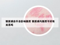 银屑病会不会影响肠胃 银屑病与肠胃不好有关系吗