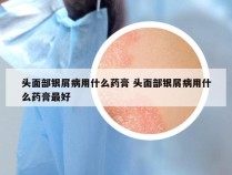 头面部银屑病用什么药膏 头面部银屑病用什么药膏最好