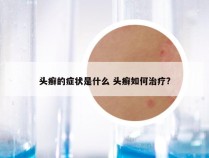 头癣的症状是什么 头癣如何治疗?