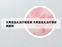 大黄蛰虫丸治疗银屑病 大黄蛰虫丸治疗银屑病案例